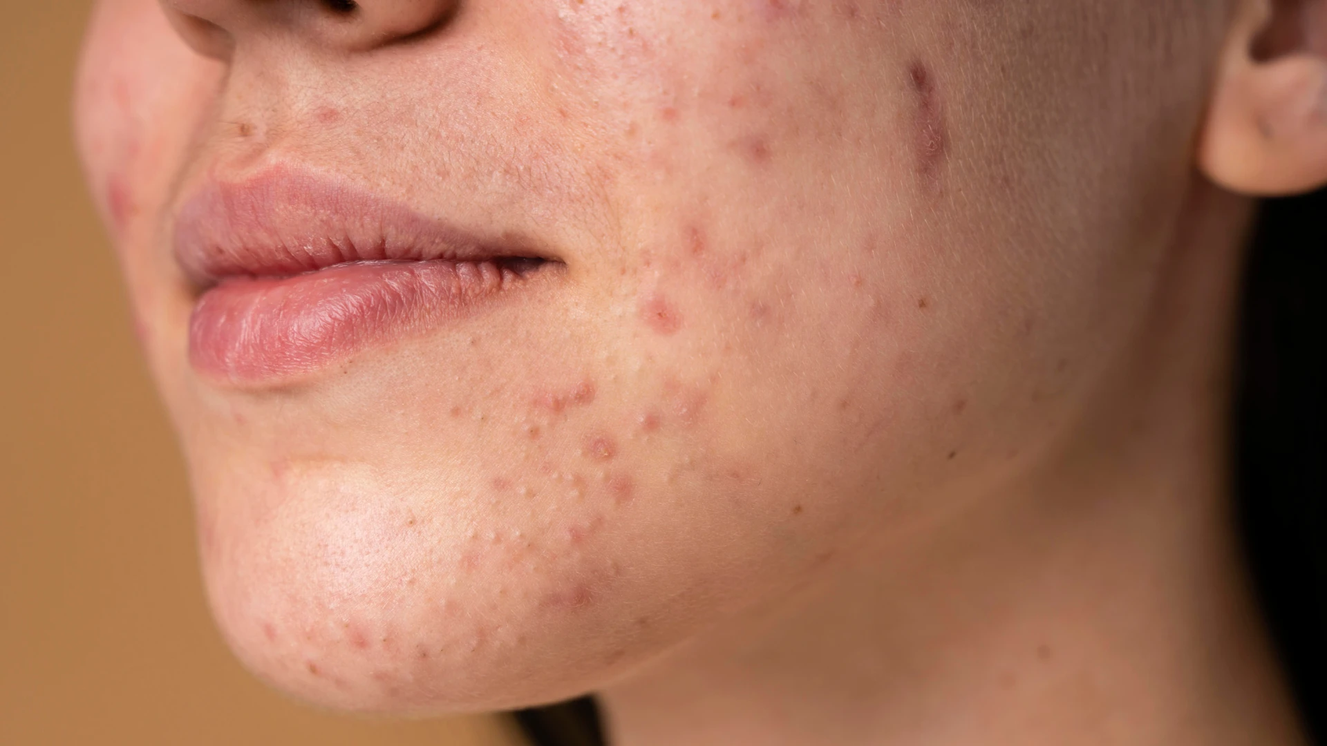Close-up of active acne breakouts on the cheek and jawline, treated at The Skin Firm Sheffield