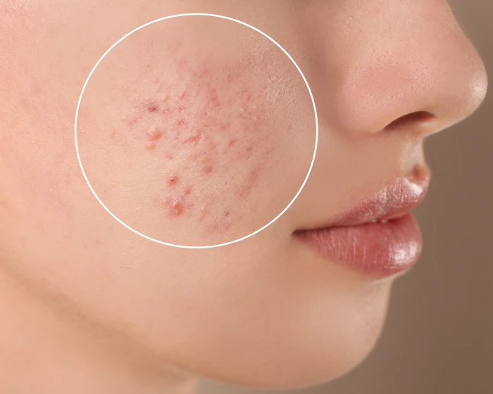 Close-up of acne breakouts on the cheek, treated at The Skin Firm Sheffield