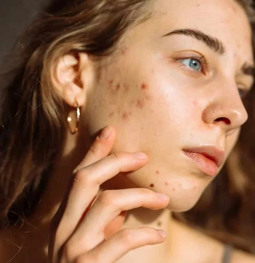 Acne & Breakouts
