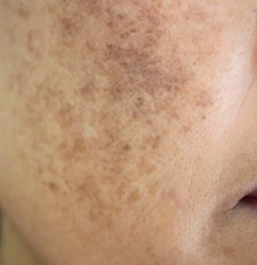 Skin concerns treated at The Skin Firm Sheffield