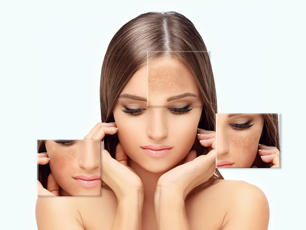 Cosmelan Depigmentation Program