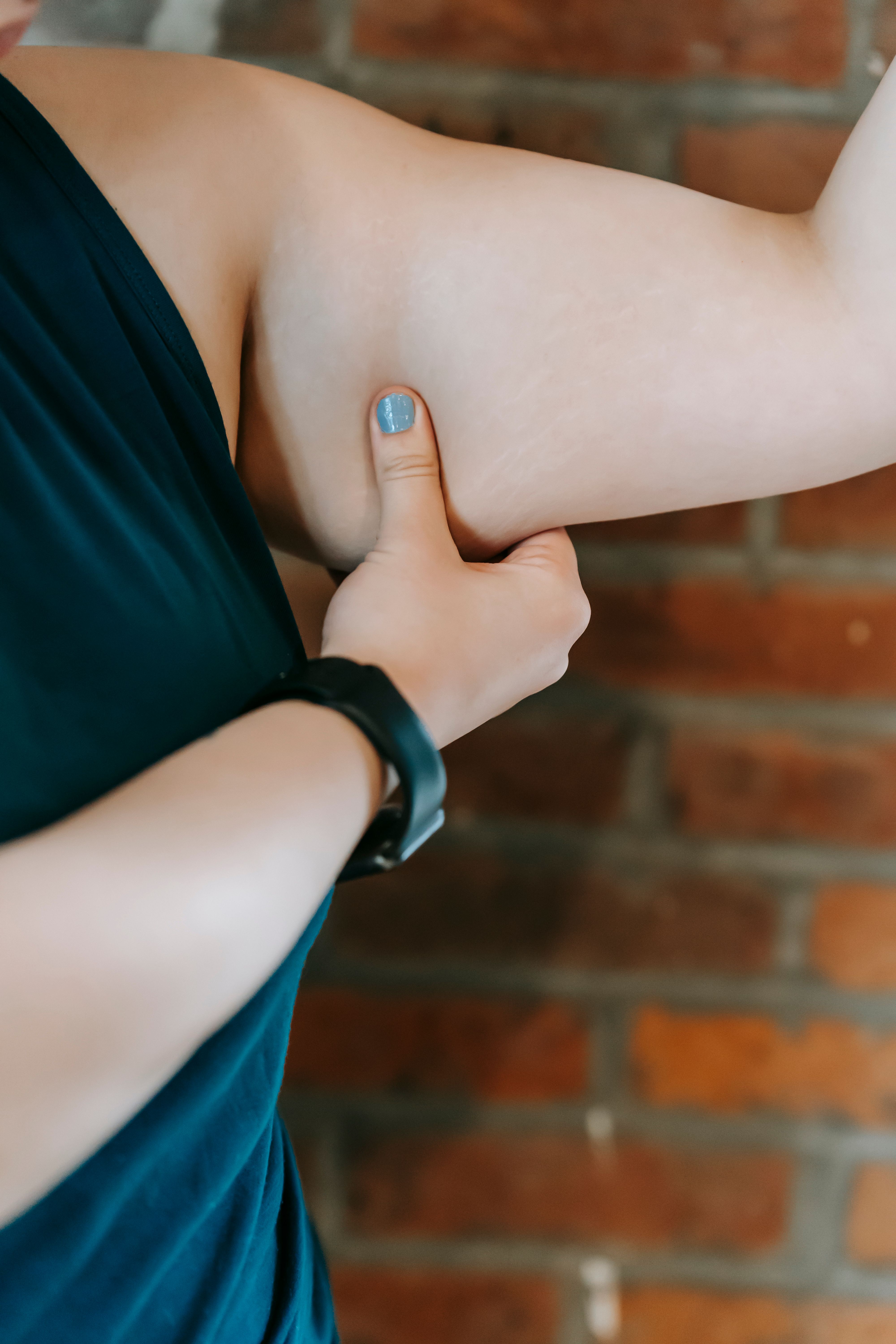 Pinching a pocket of stubborn upper-arm fat, the kind fat dissolving injections target