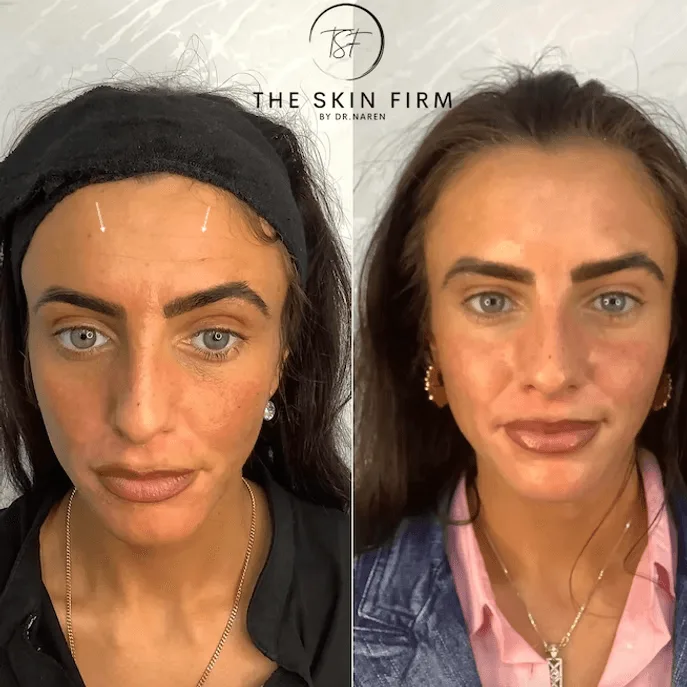 Anti-Wrinkle Treatment before and after at The Skin Firm