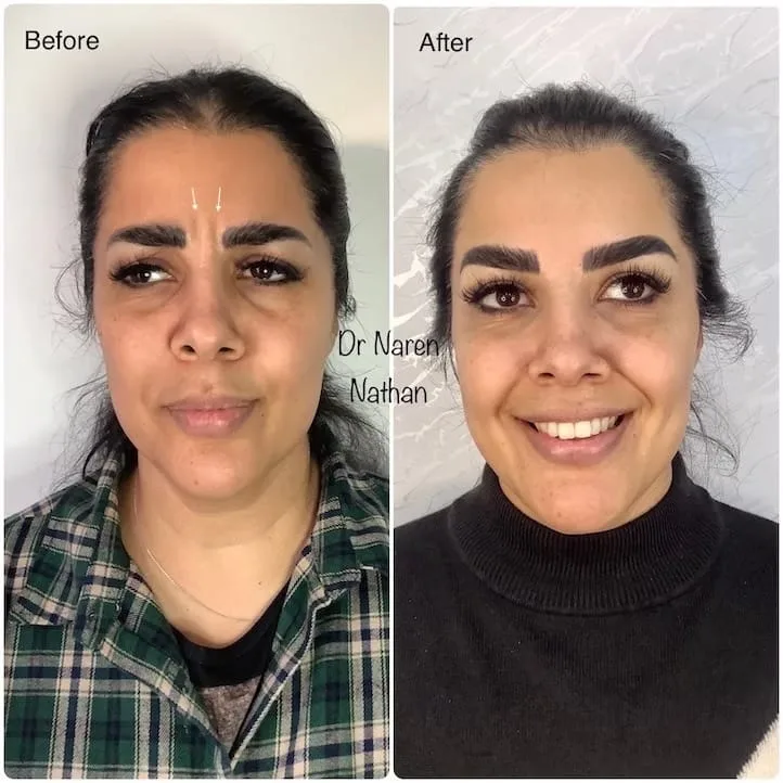 Anti-Wrinkle Treatment before and after at The Skin Firm