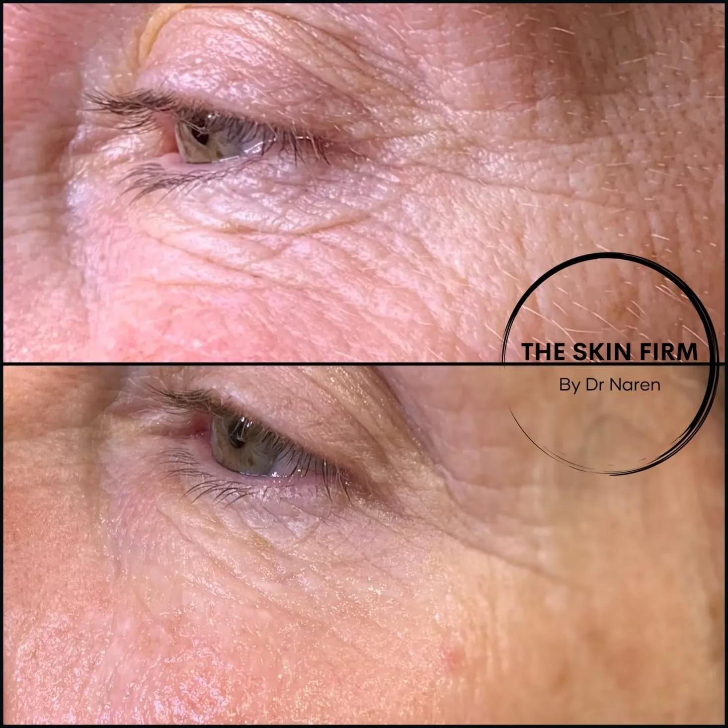 Anti-Wrinkle Treatment before and after at The Skin Firm