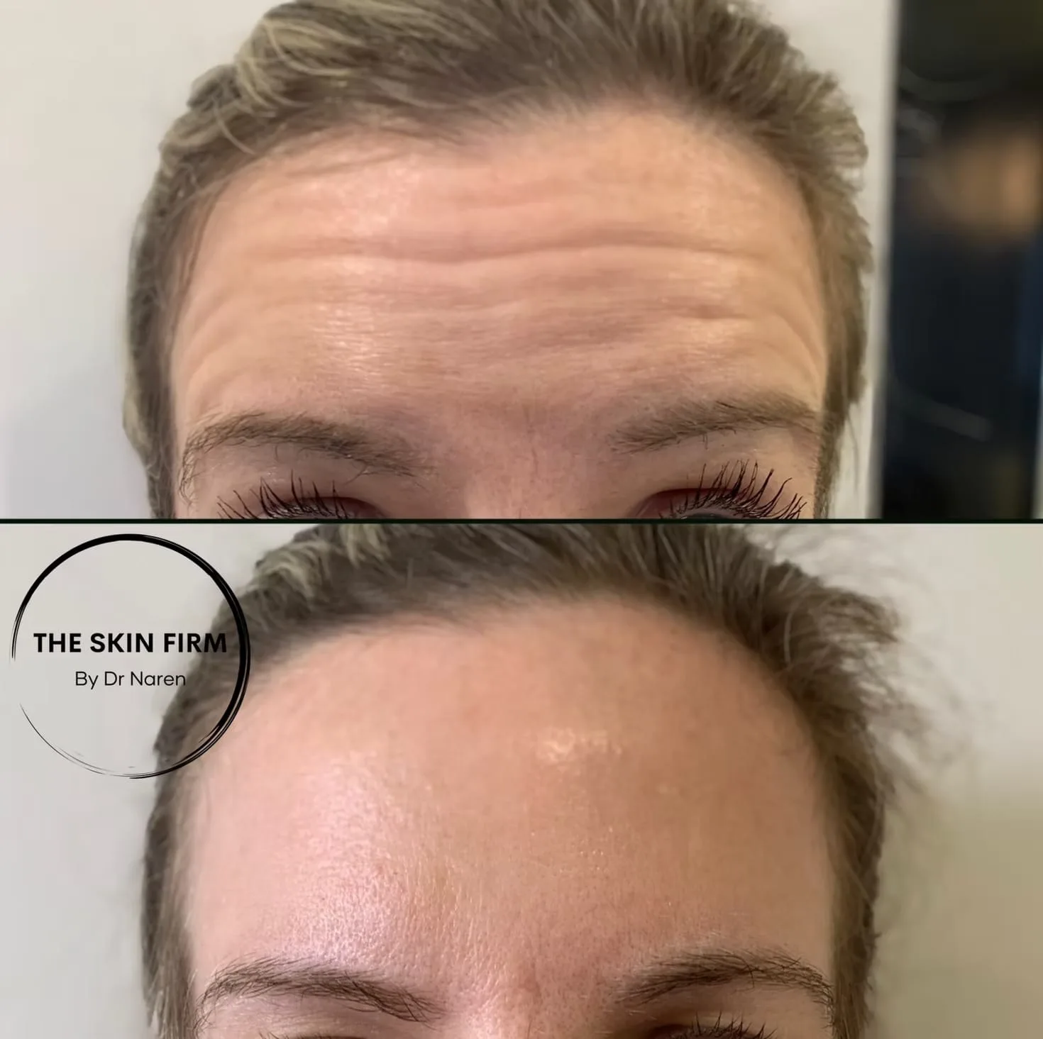 Anti-Wrinkle Treatment before and after at The Skin Firm