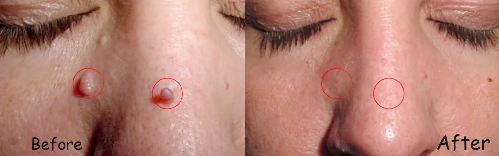 CryoPen Minor Surgery before and after at The Skin Firm