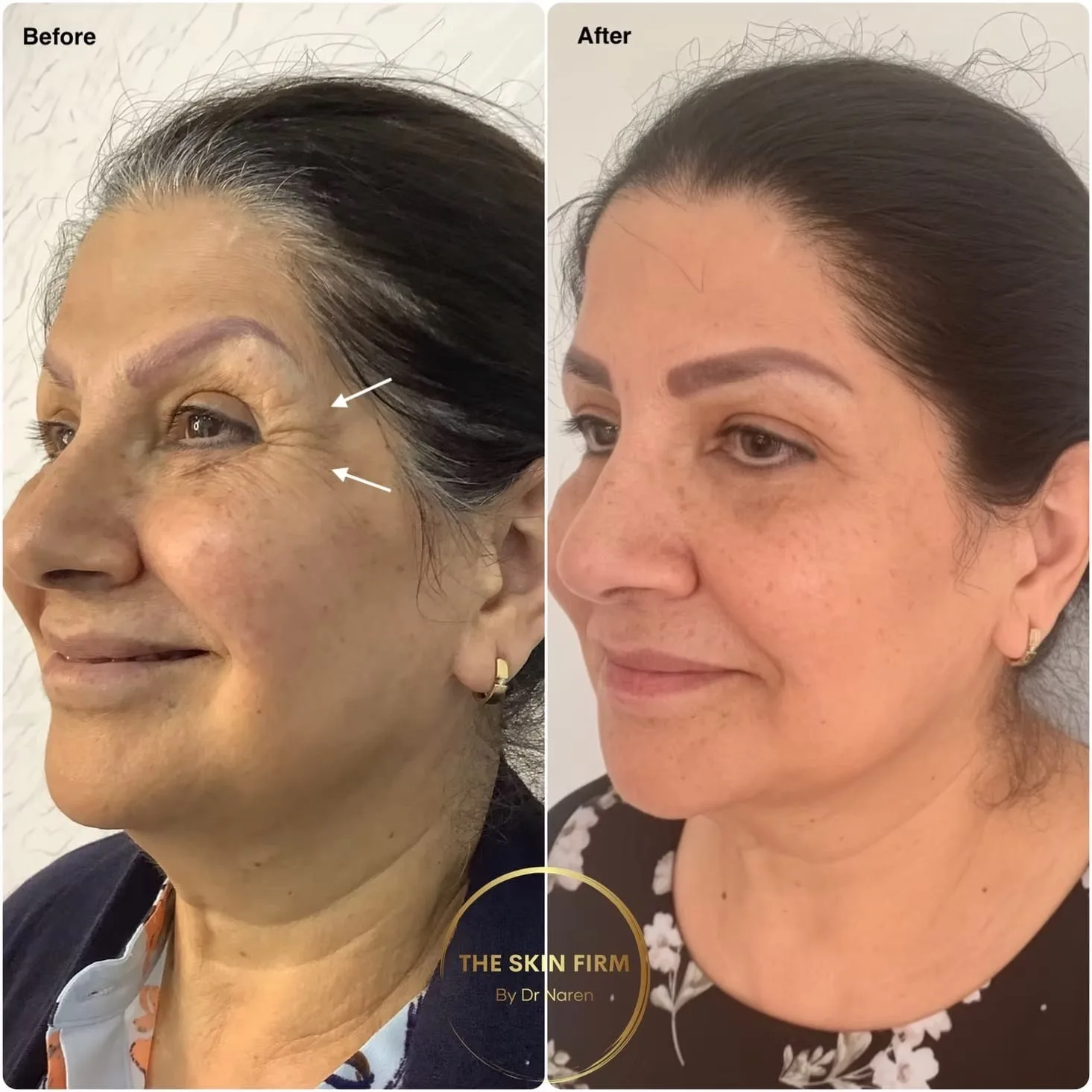 Dermal Filler Before & After