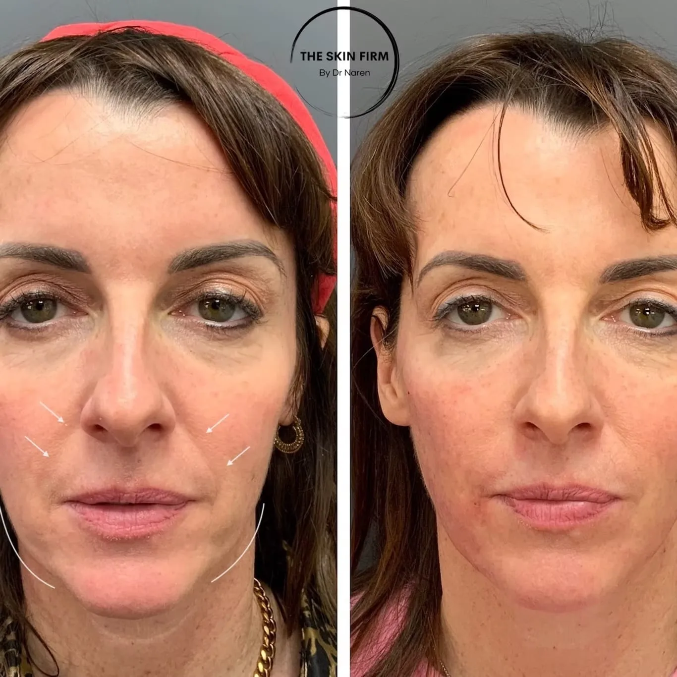 Dermal Filler Before & After