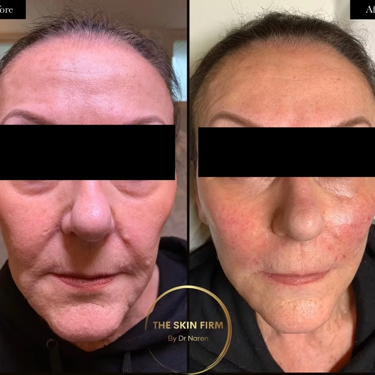 Polynucleotide Treatment Before & After
