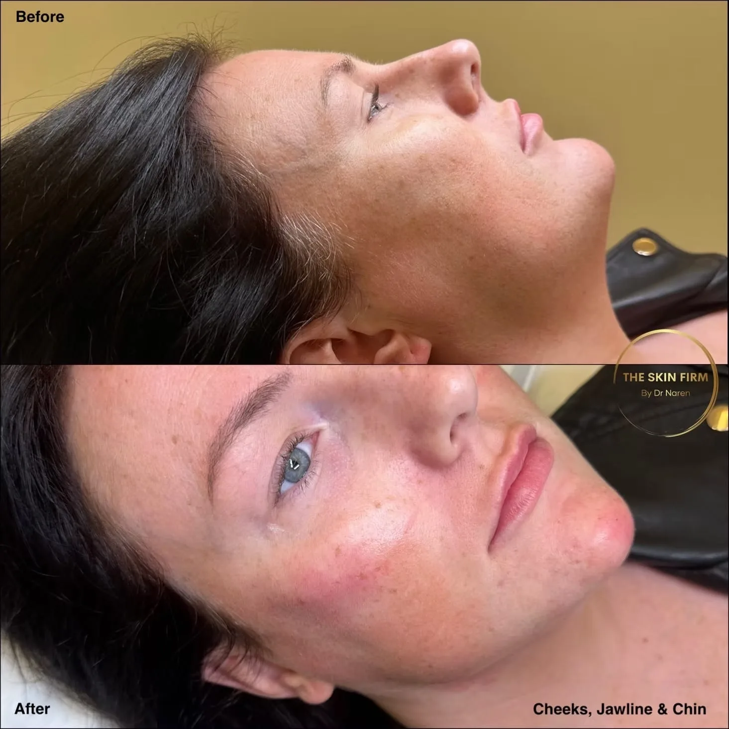 Dermal Filler Before & After