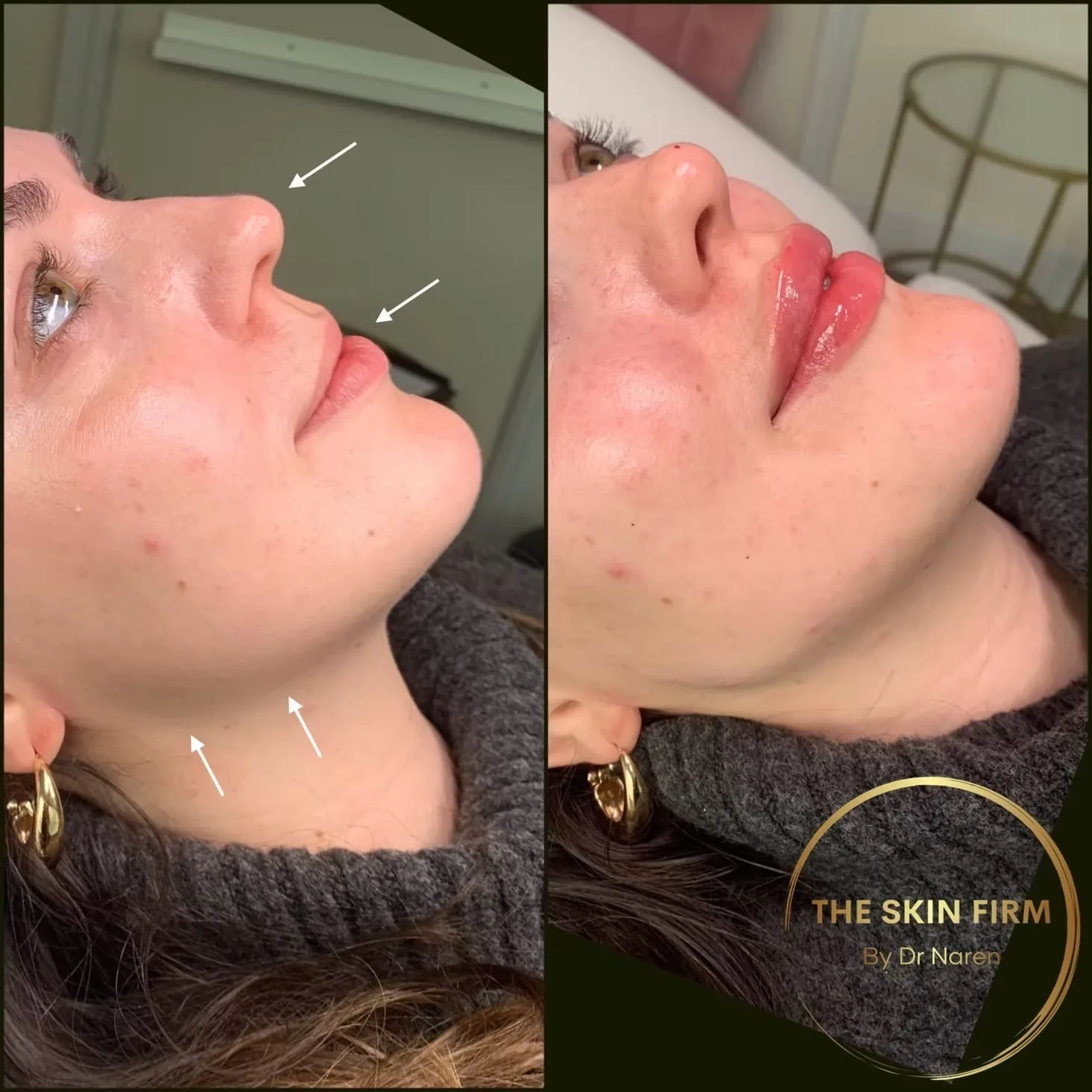 Dermal Filler Before & After
