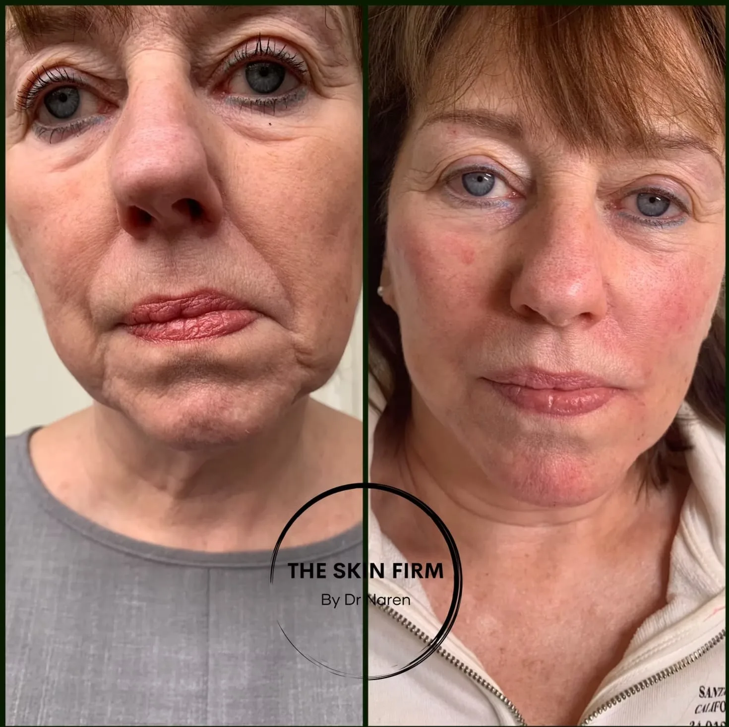 Dermal Filler Before & After