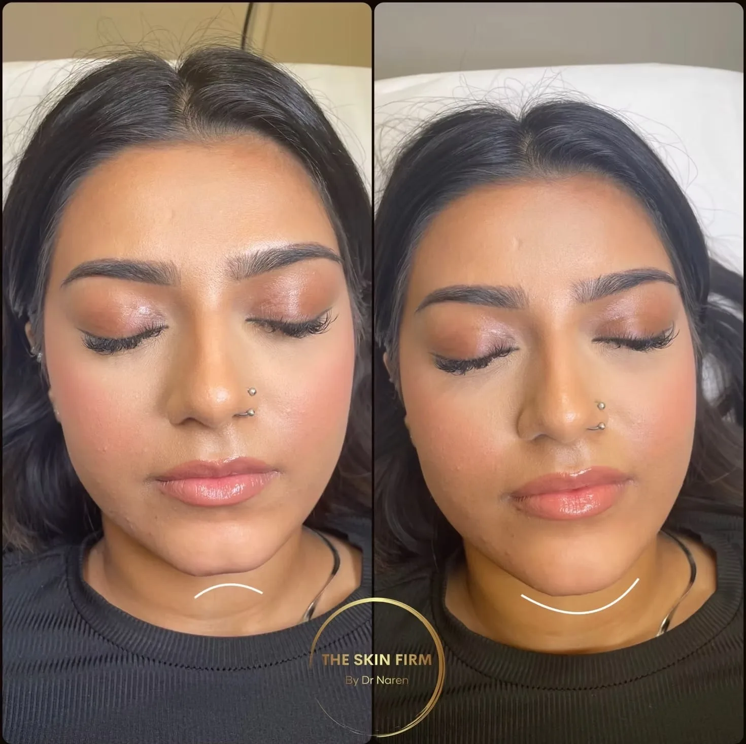 Dermal Filler Before & After