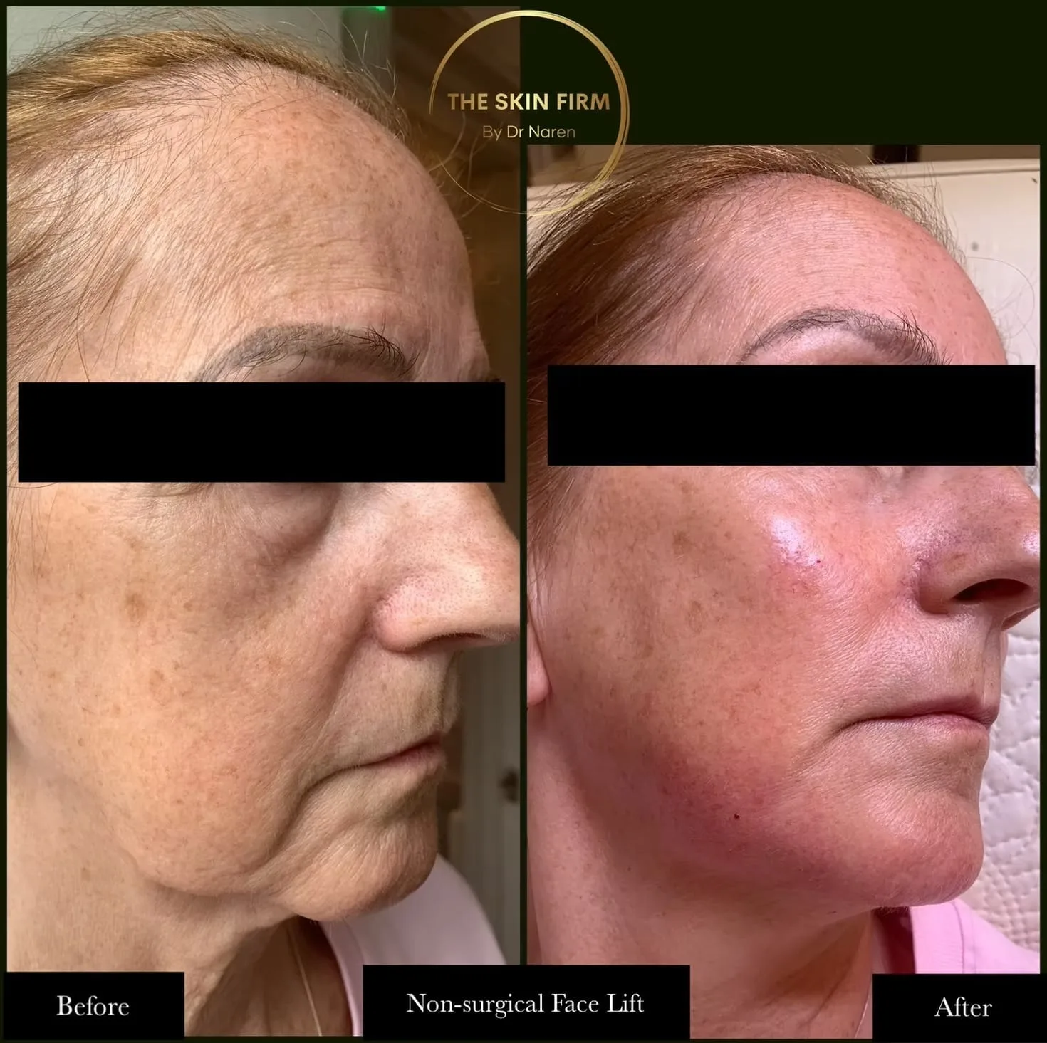 Non-Surgical Face Lift before and after at The Skin Firm