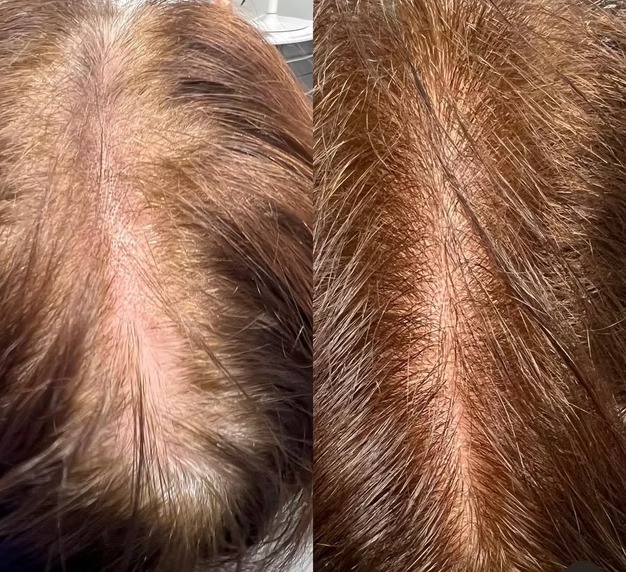 E-50 Exosomes for Hair before and after at The Skin Firm