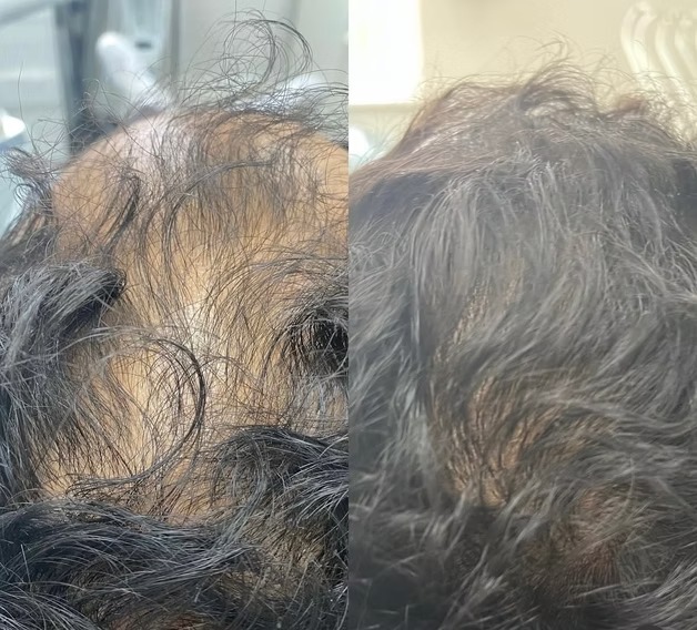E-50 Exosomes for Hair before and after at The Skin Firm