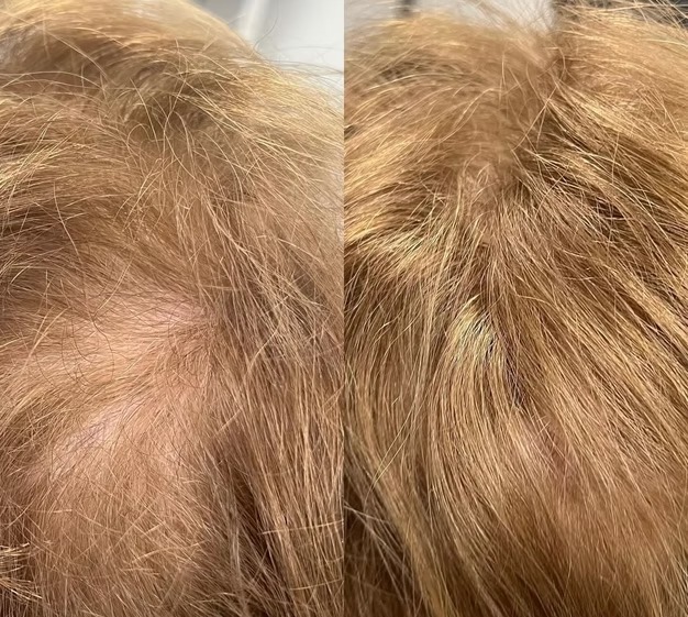E-50 Exosomes for Hair before and after at The Skin Firm