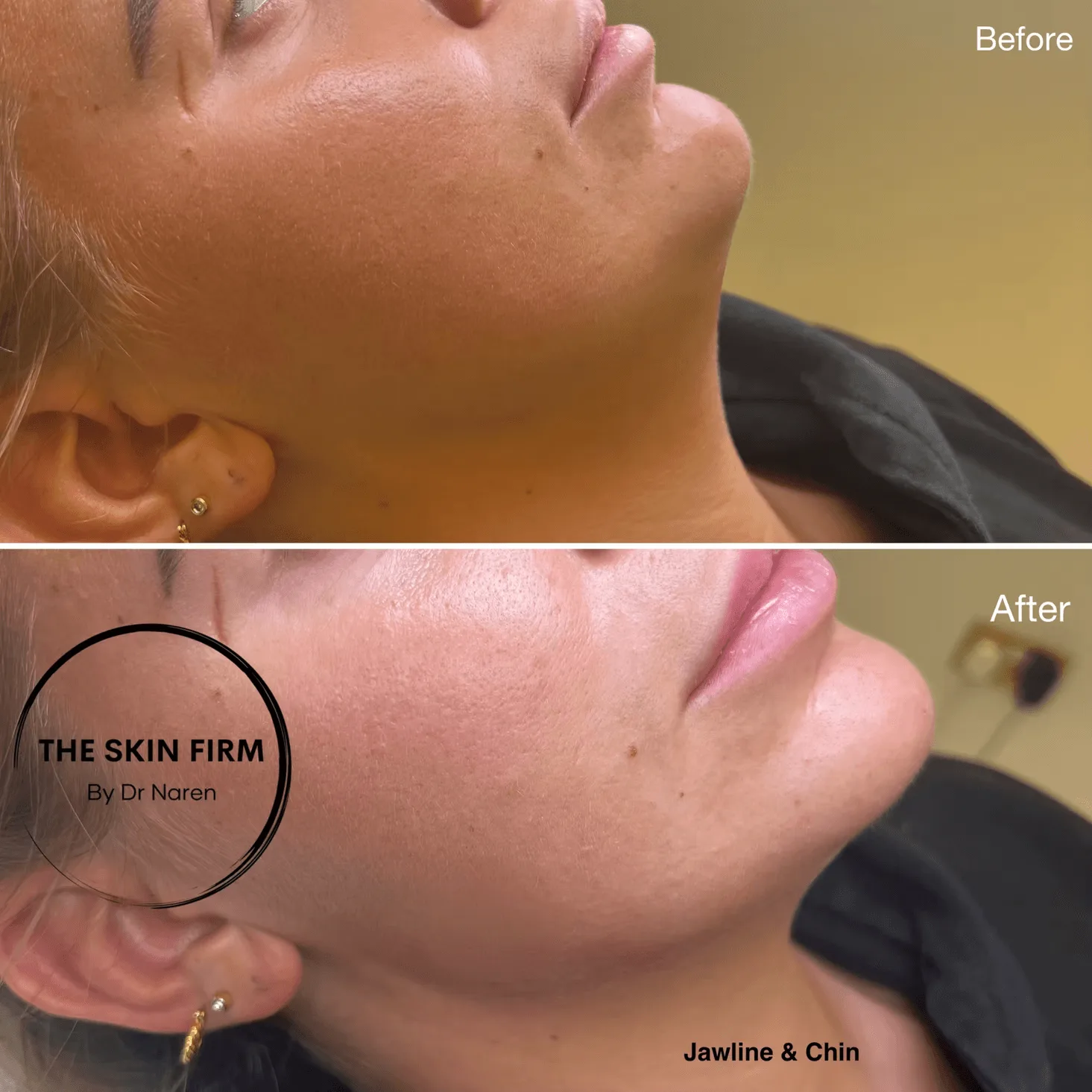 Jawline & Chin Filler before and after at The Skin Firm