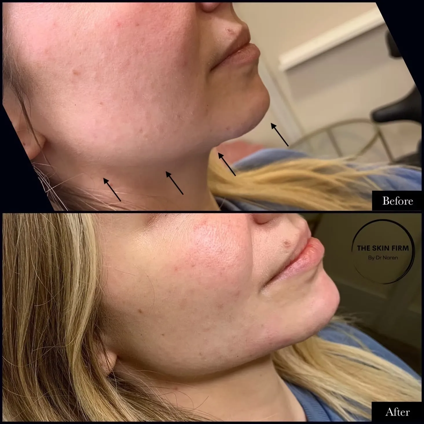 Jawline & Chin Filler before and after at The Skin Firm