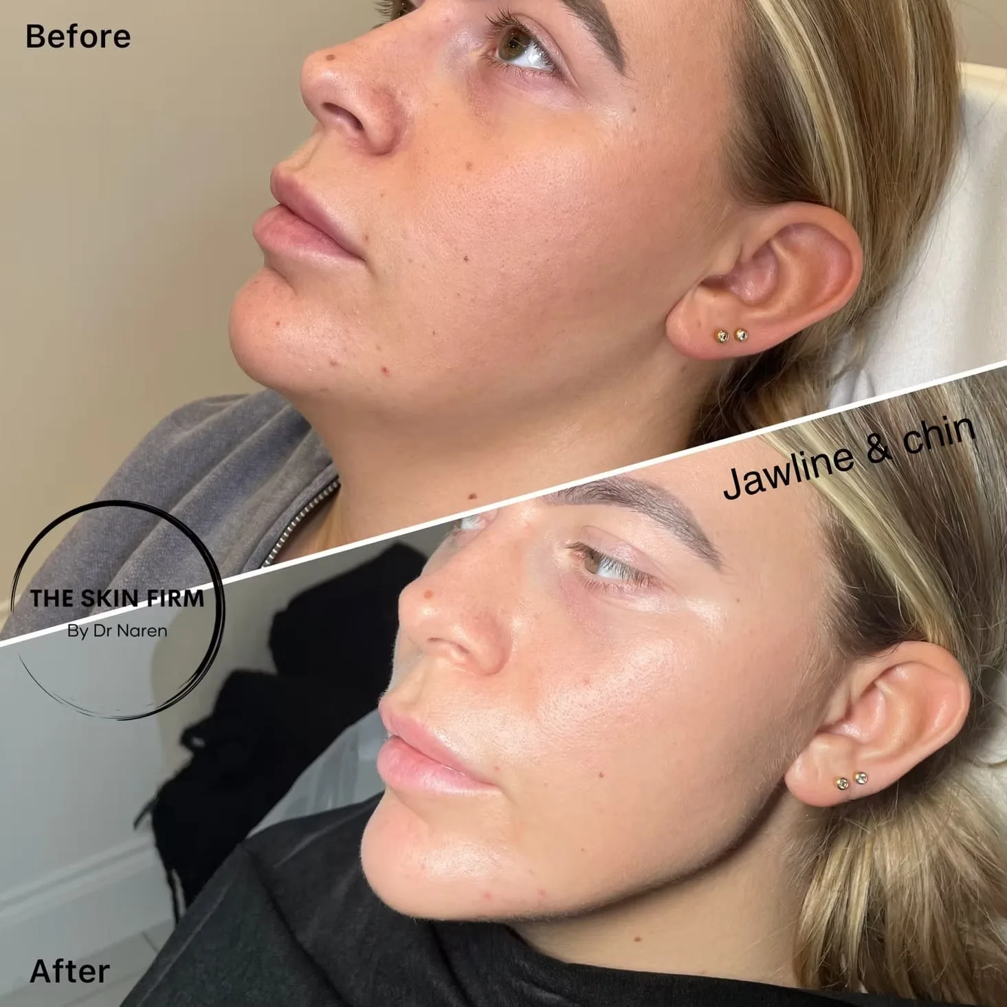 Jawline & Chin Filler before and after at The Skin Firm