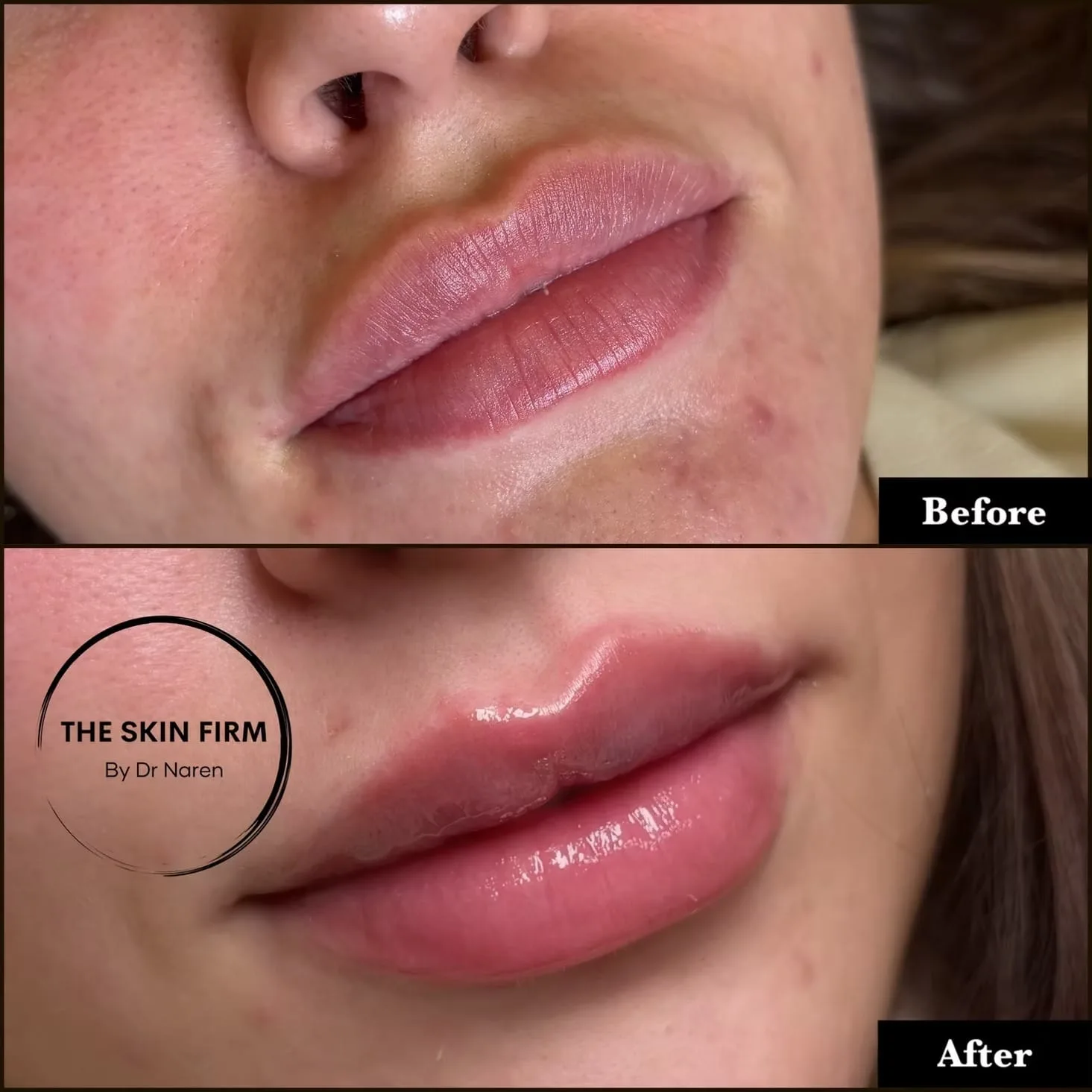 Lip Fillers before and after at The Skin Firm