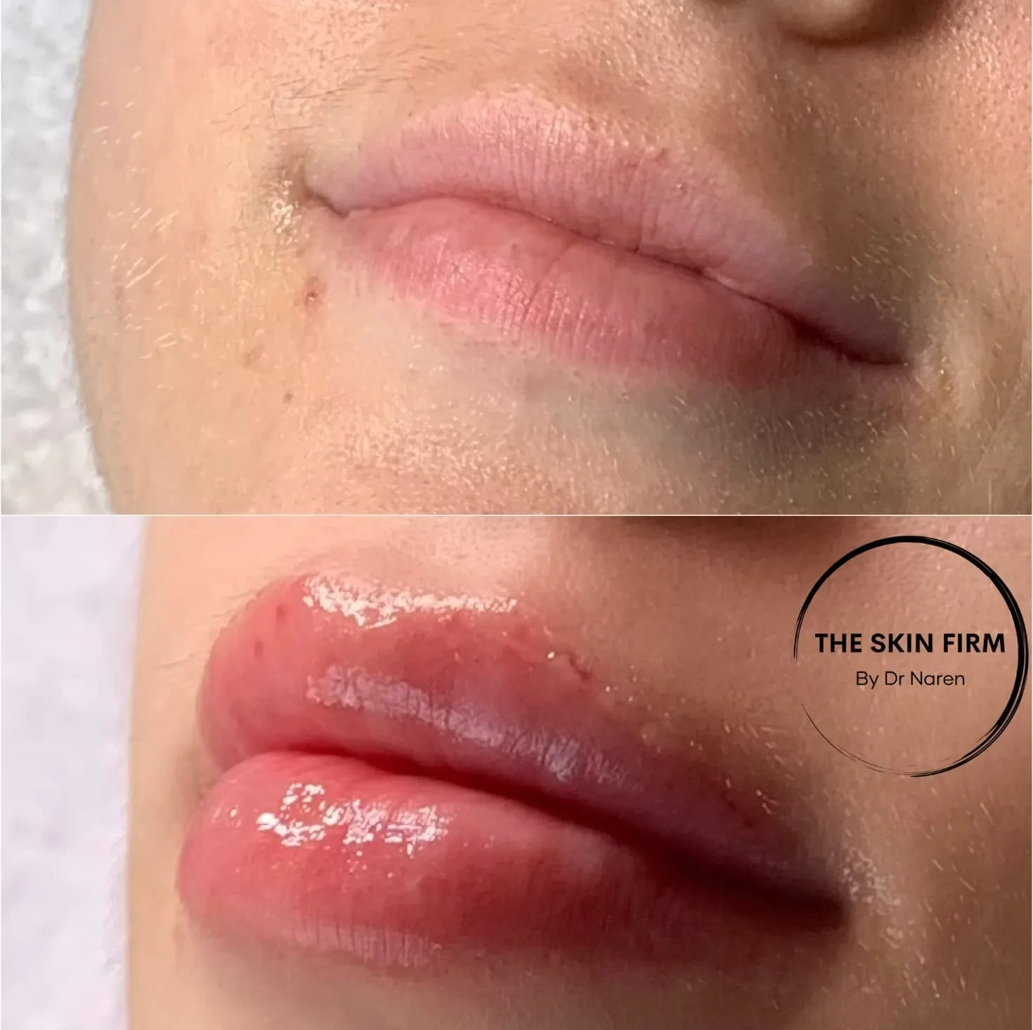 Lip Fillers before and after at The Skin Firm