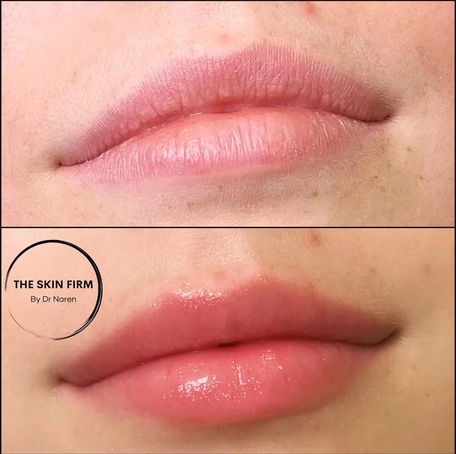 Lip Fillers before and after at The Skin Firm