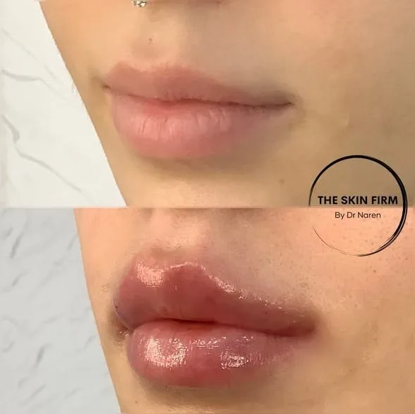 Polynucleotide Treatment Before & After