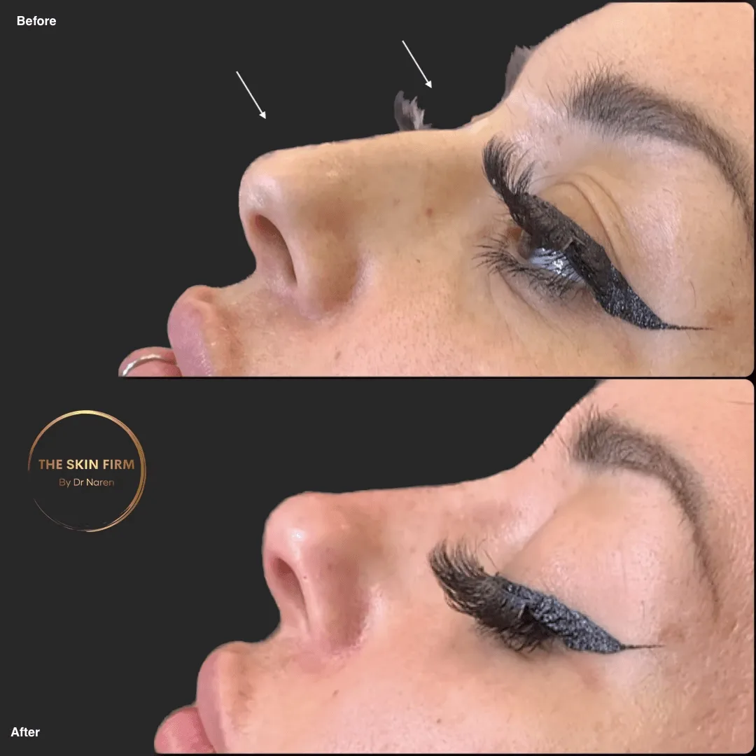 Dermal Filler Before & After