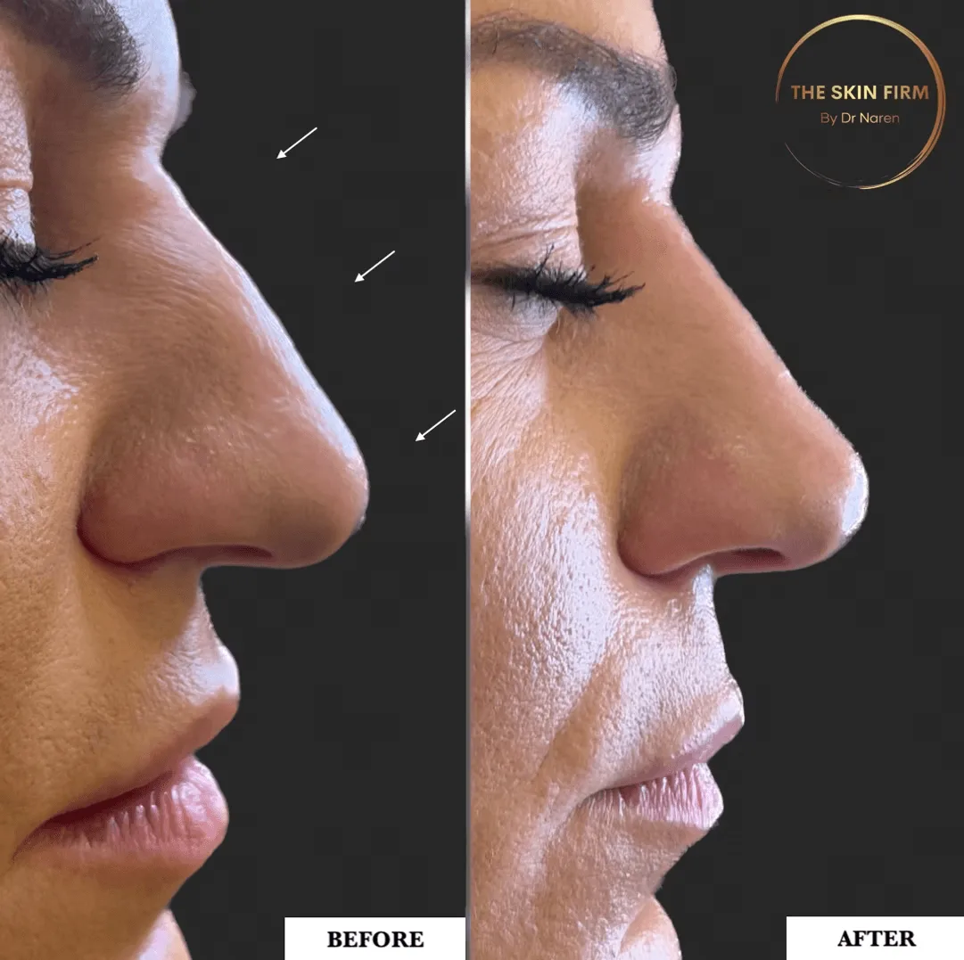 Non-Surgical Rhinoplasty before and after at The Skin Firm