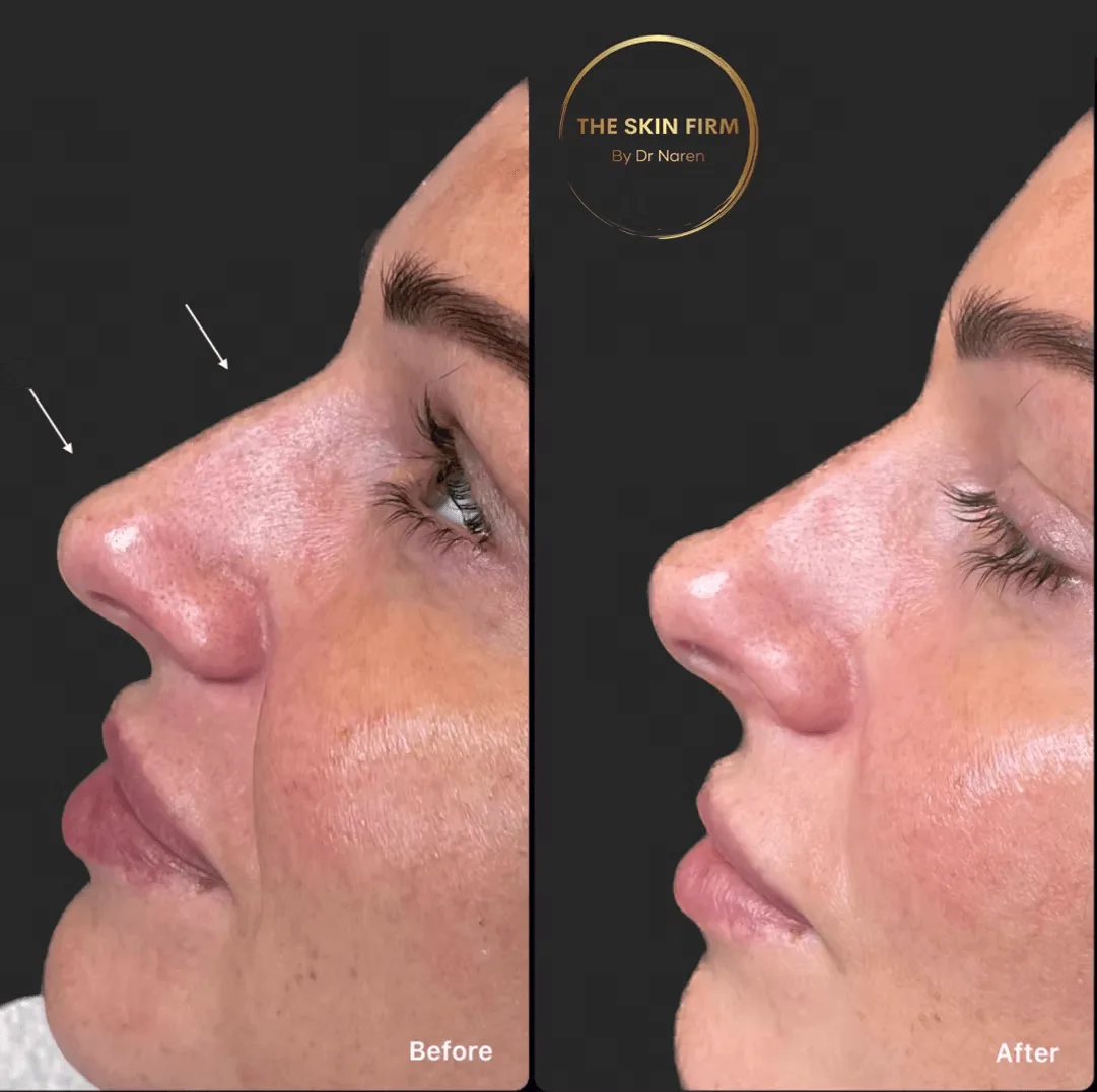 Dermal Filler Before & After