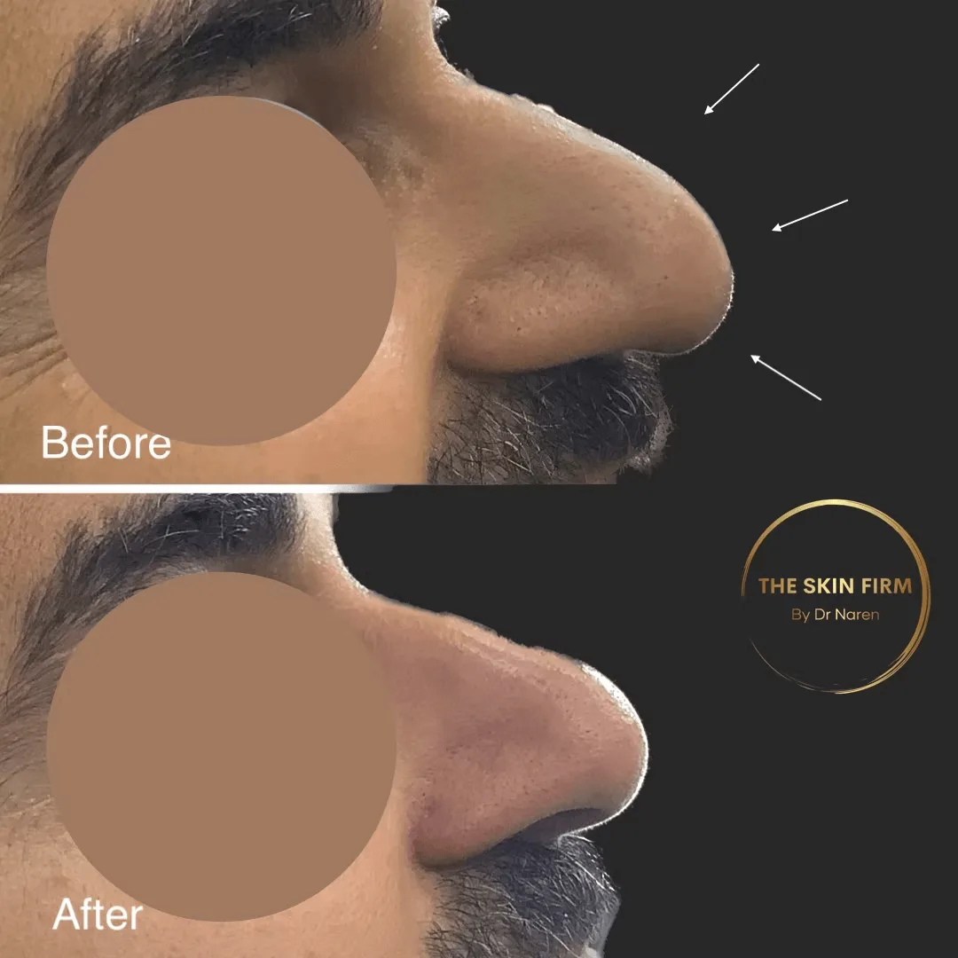 Non-Surgical Rhinoplasty before and after at The Skin Firm