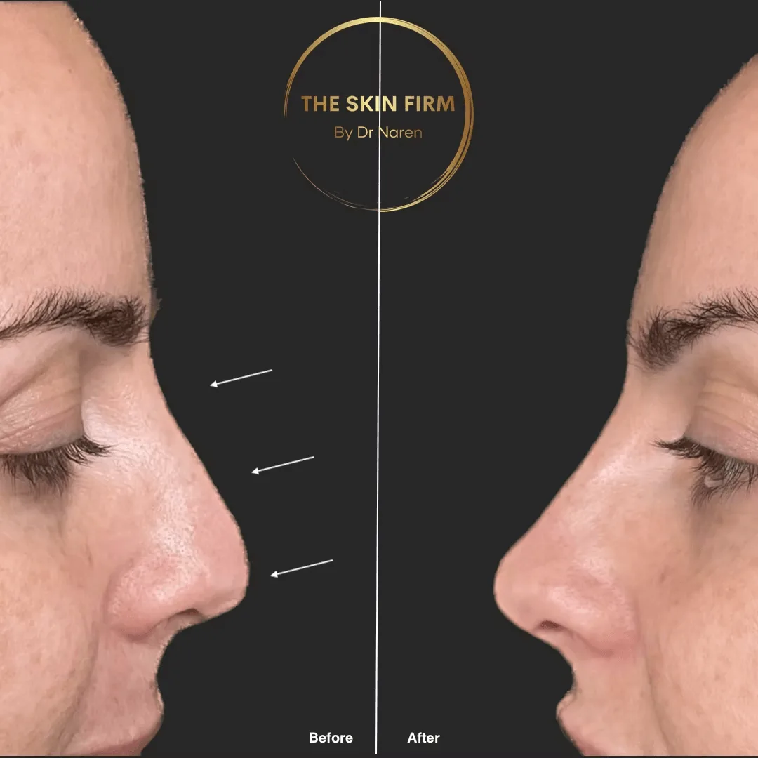 Non-Surgical Rhinoplasty before and after at The Skin Firm