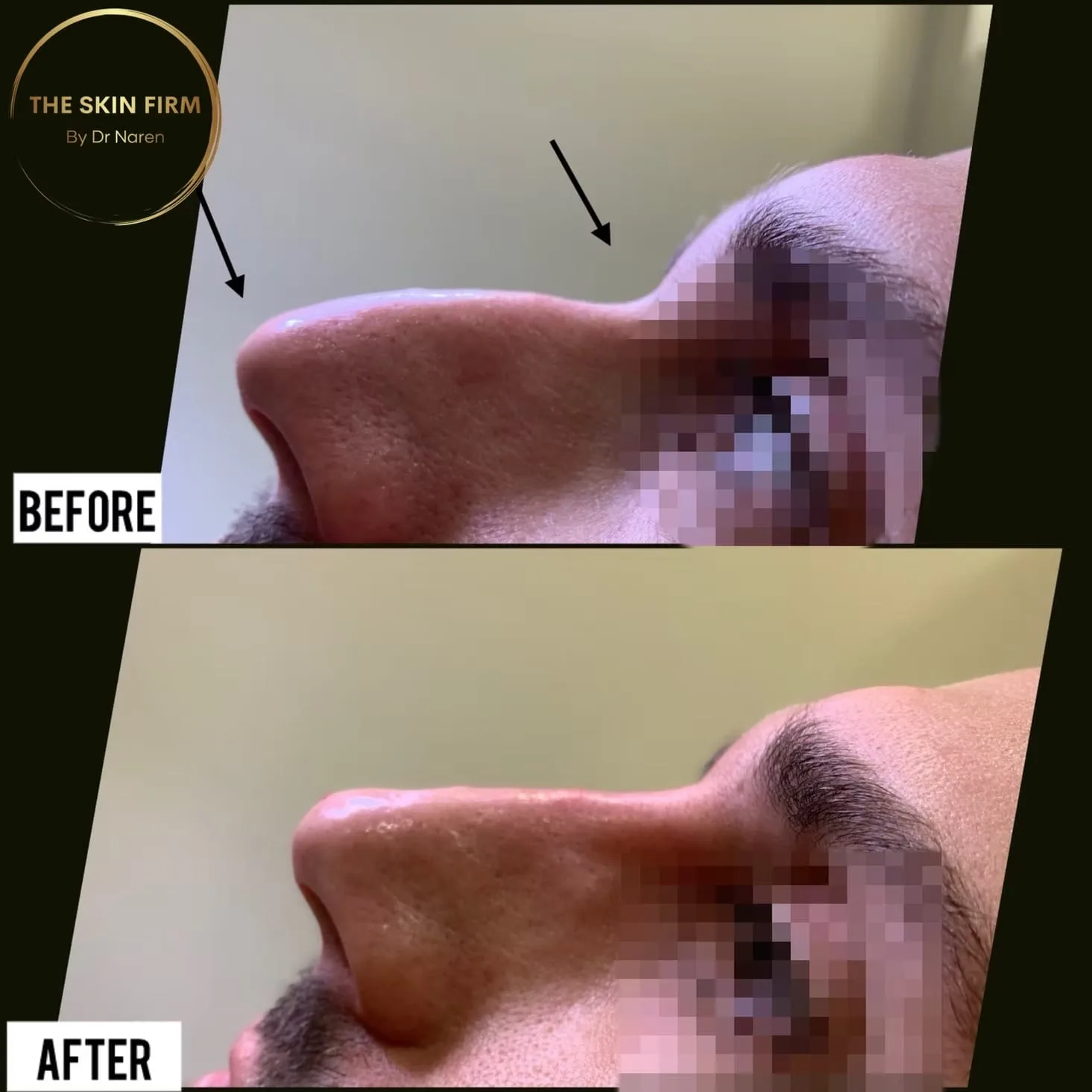 Non-Surgical Rhinoplasty before and after at The Skin Firm