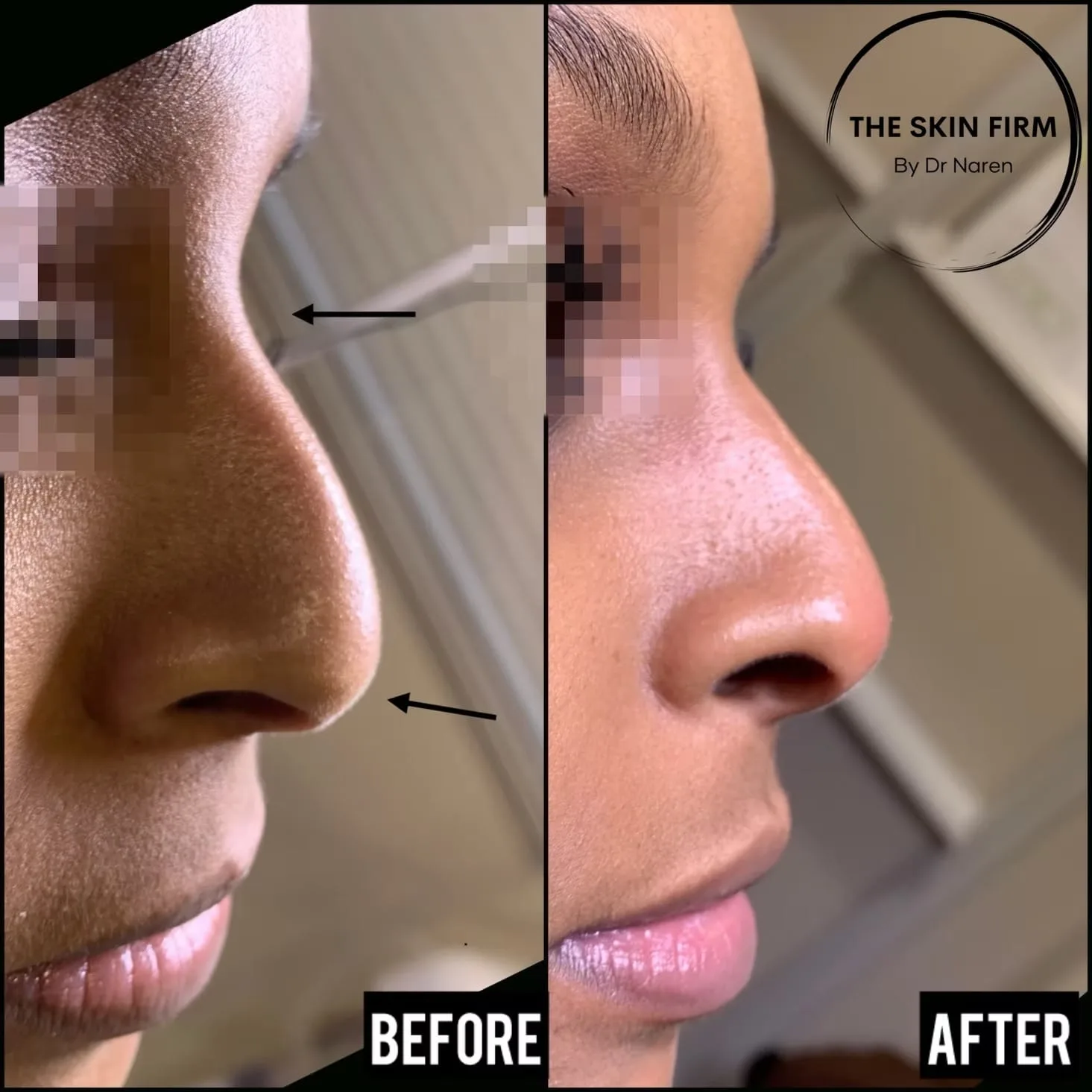 Non-Surgical Rhinoplasty before and after at The Skin Firm